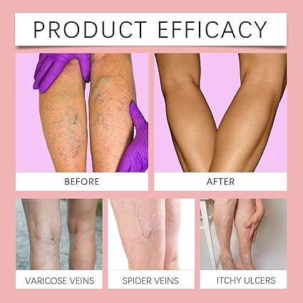 Varicose Veins Crema para Várices